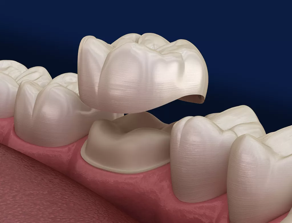 DENTAL CROWN AND BRIDGE IMPLANT